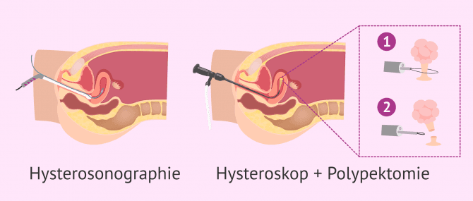Imagen: Hysterosonographie und Hysteroskop Polypen
