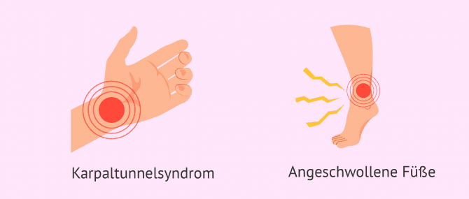 Imagen: Karpaltunnelsyndrom