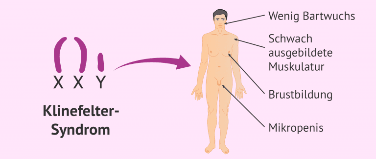 Klinefelter Syndrom Was Ist Das