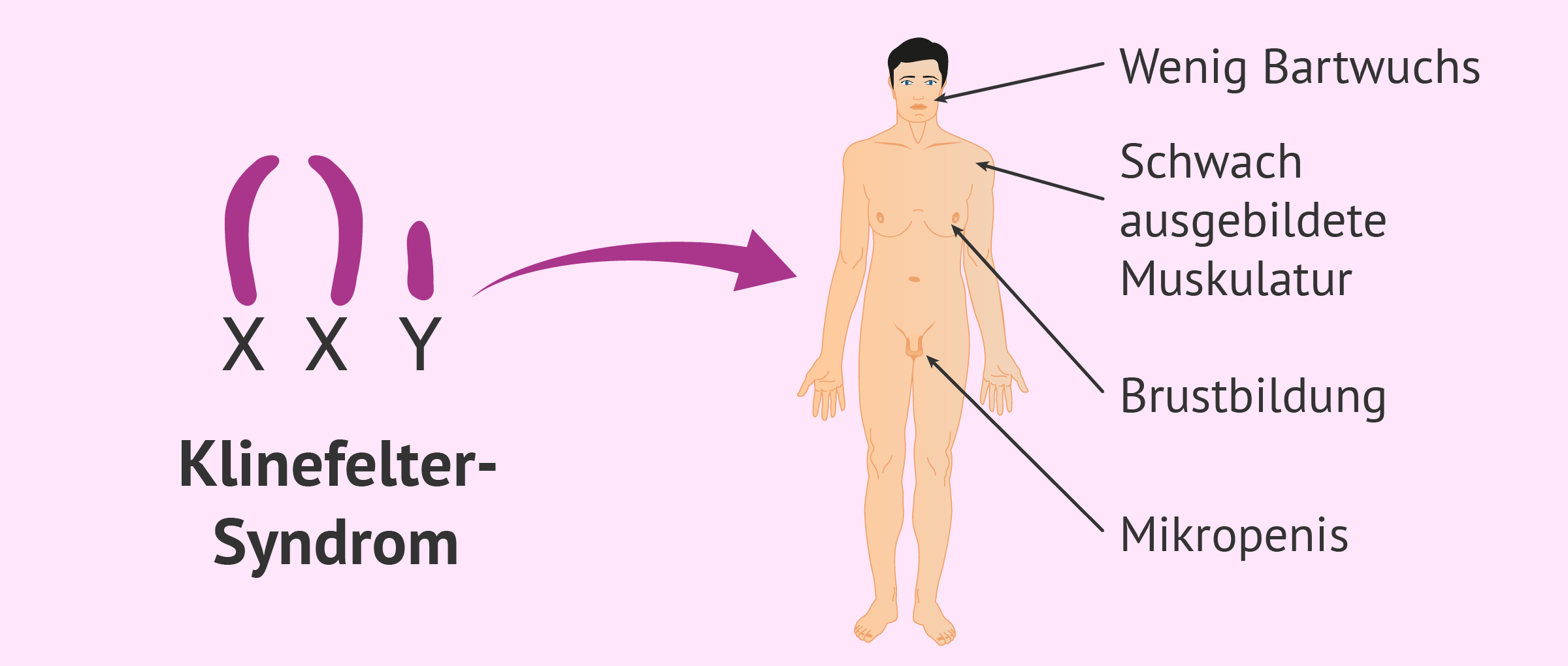 Merkmale des Klinefelter-Syndroms