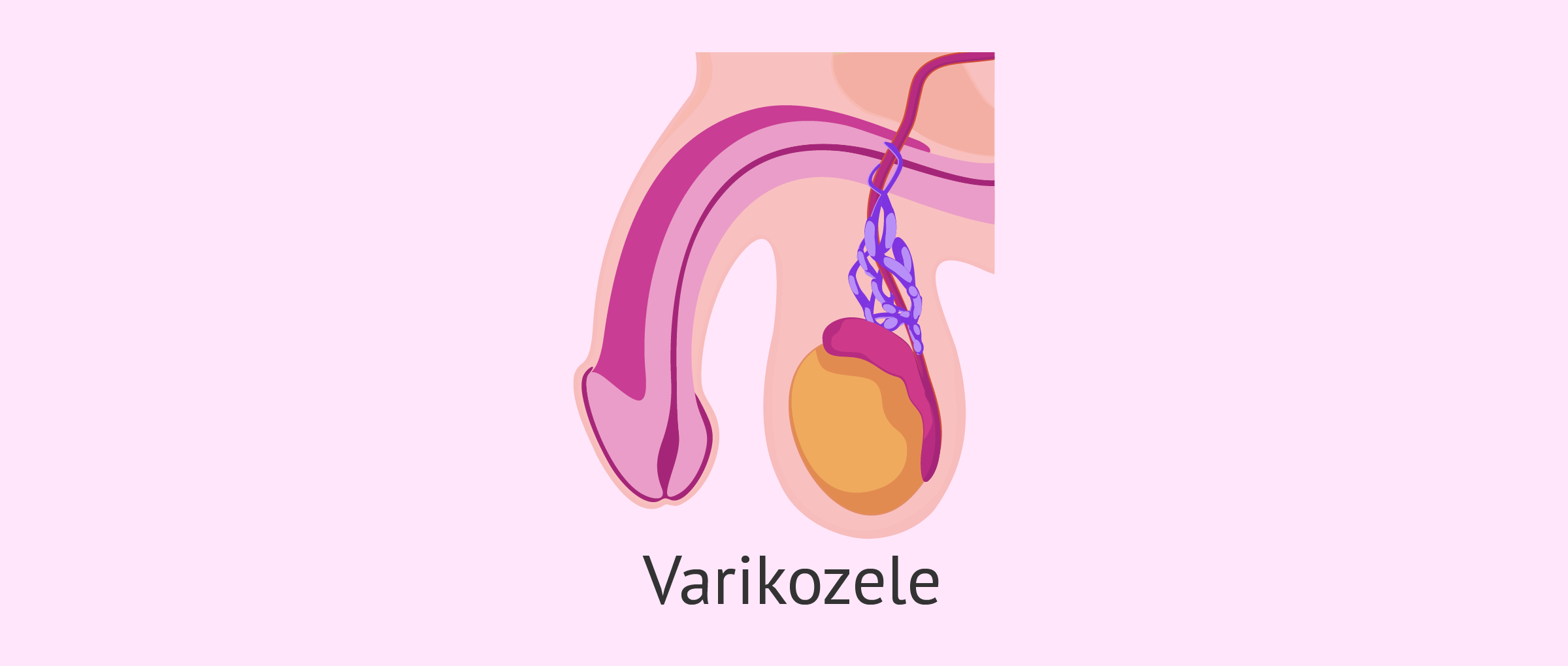 Varikozele (Krampfaderbruch)