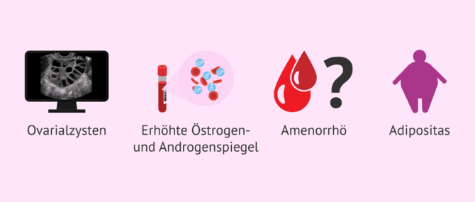 Imagen: Typische Merkmale bei Frauen mit PCOS