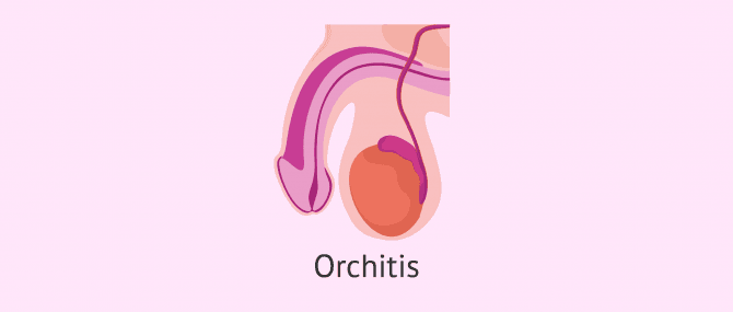 Imagen: Orchitis