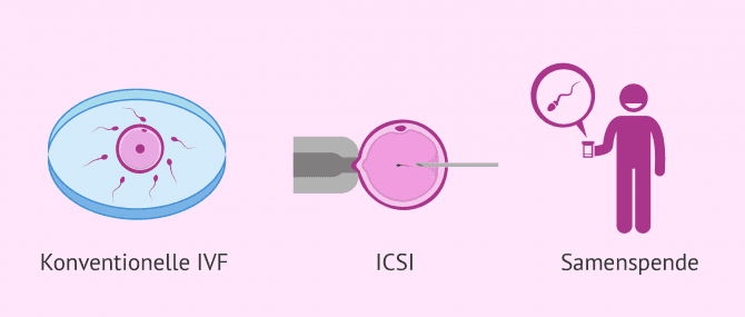 Imagen: Lösungen bei Astenozoospermie um schwanger zu werden