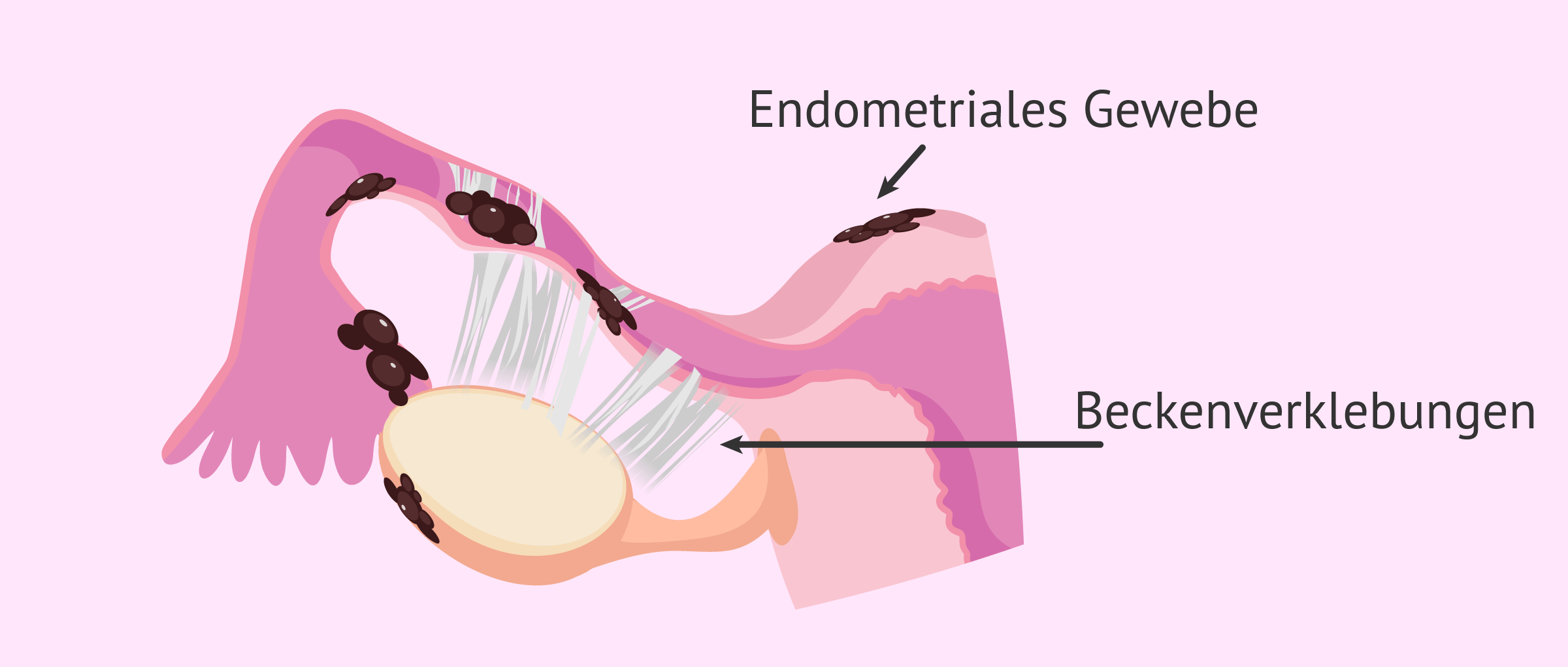 Eileiterfaktor aufgrund von Endometriose