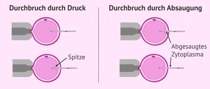 Imagen: Arten von ICSI