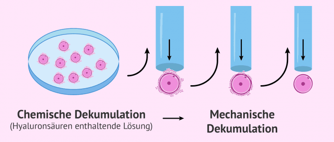 Imagen: Dekumulation Verlauf