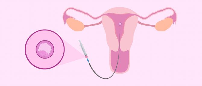 Imagen: Embryotransfer in die Gebärmutter