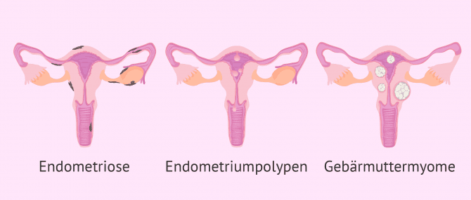 Imagen: Krankheiten die das Endometrium beeinträchtigen