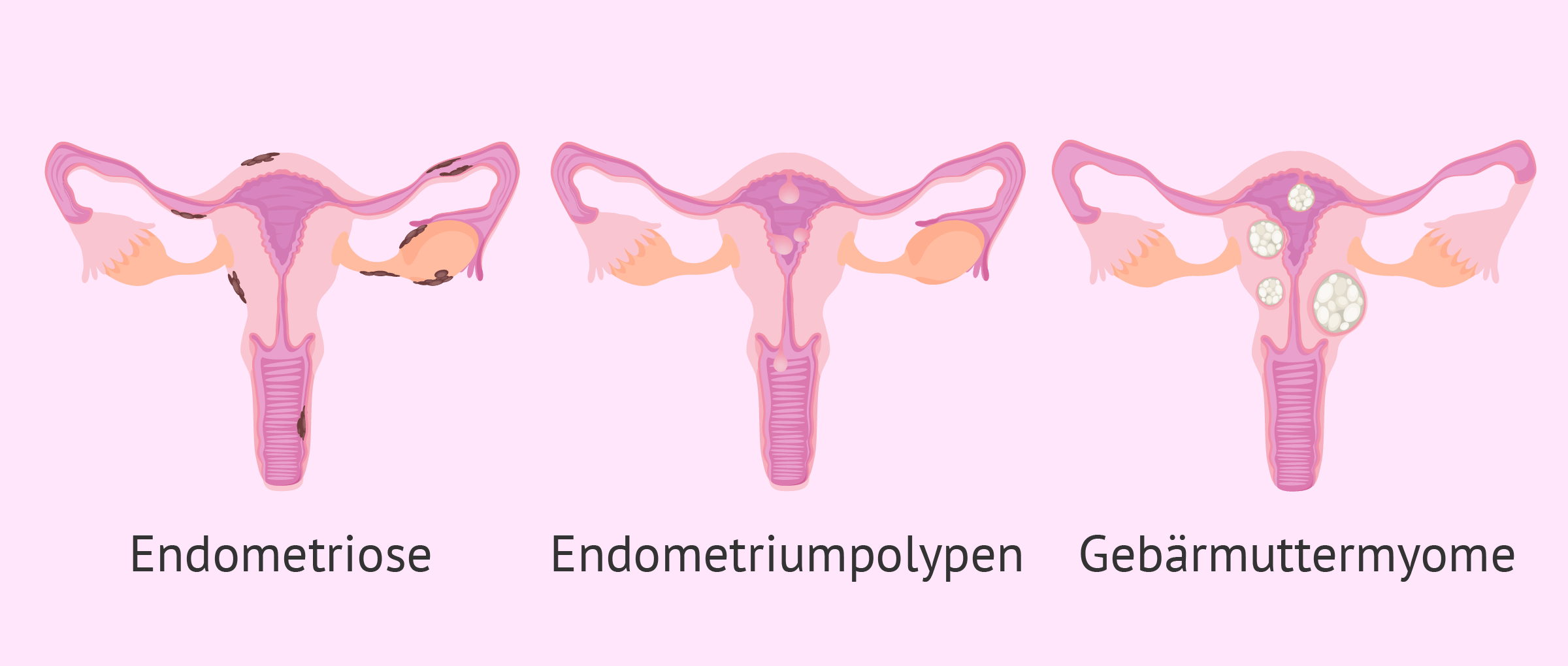 Krankheiten die das Endometrium beeinträchtigen