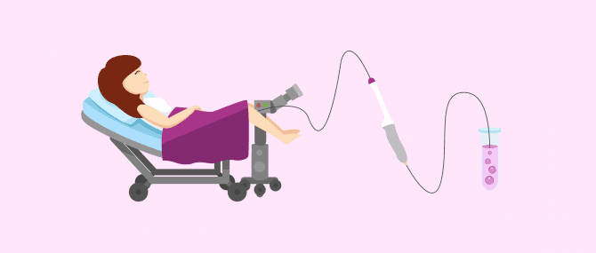 Imagen: Follikelpunktion zur Entnahme von Eizellen