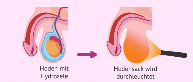Imagen: Hoden wird durchleuchtet