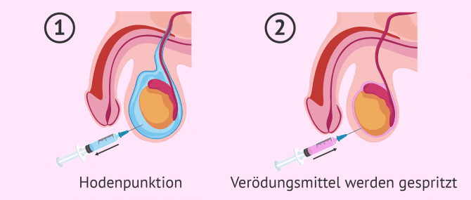 Imagen: Hodenabsaugung und Verödung