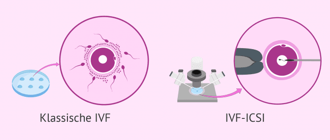 Imagen: IVF vs ICSI: Was ist der Unterschied?