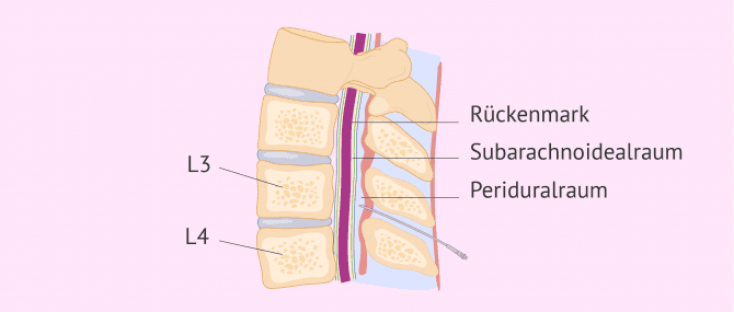 Imagen: Für die Geburt PDA setzen