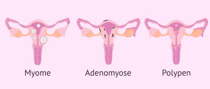 Imagen: Polypen, Miome, Adenomyose