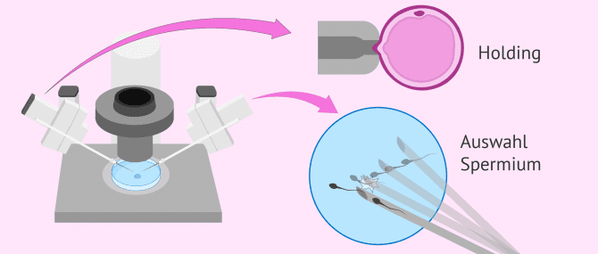Imagen: Prozess ICSI Holding Auswahl Spermien