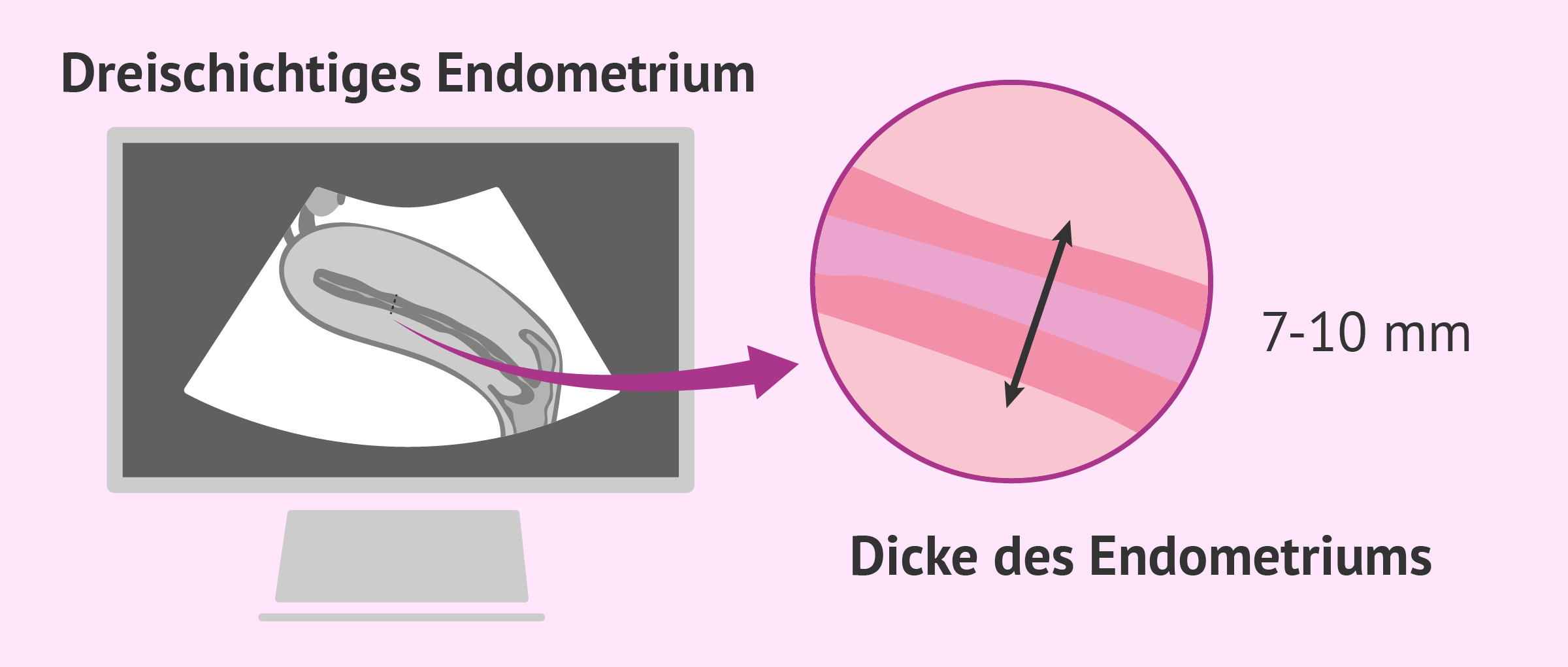 Ultraschall zur Untersuchung des Endometriums