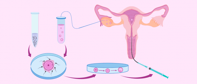 Imagen: Verlauf einer IVF