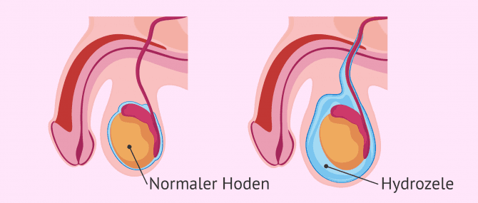 Imagen: Was ist eine Hydrozele?