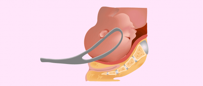 Imagen: Zangengeburt