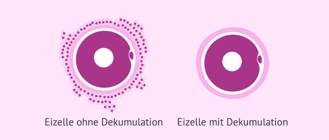 Imagen: Dekumulation der Eizellen