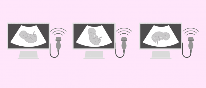 Imagen: Fötusstellungen, bei denen ein Kaiserschnitt notwendig ist