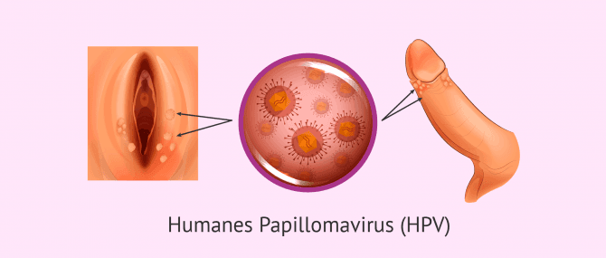 Imagen: Genitalwarzen durch HPV