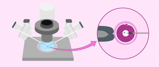 Imagen: ICSI im Mikroinjektor