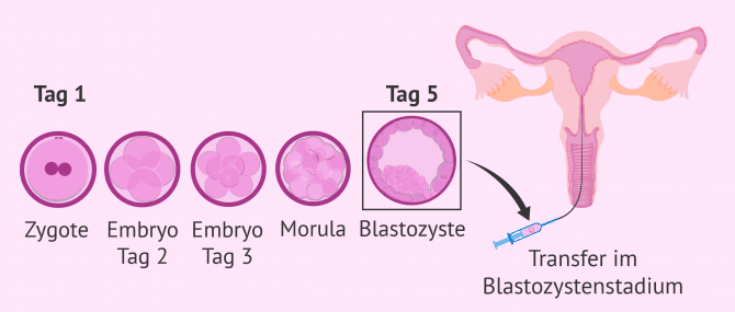 Imagen: Längere Kultur für den Transfer von Blastozysten