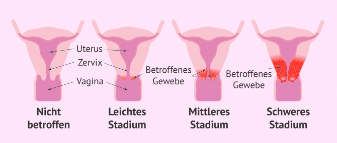 Imagen: Die verschiedenen Stadien des Zervixkarzinoms