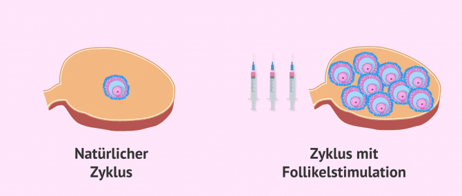 Imagen: Normaler Zyklus vs. stimulierter Zyklus