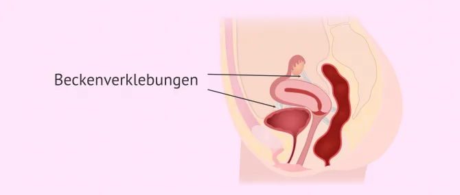 Imagen: Beckenverklebungen bei der Frau