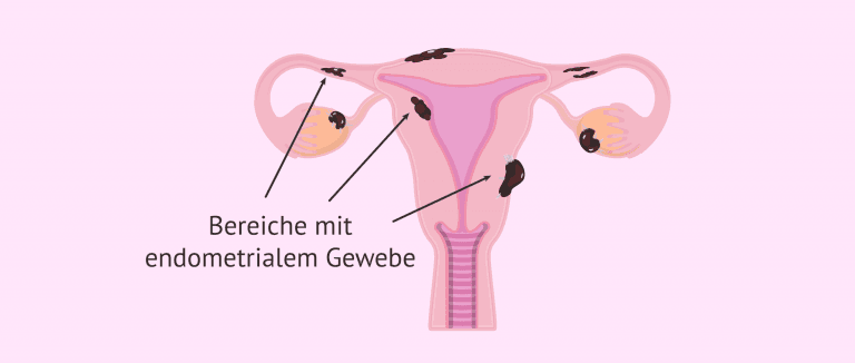 Endometriose Ohne Gebärmutter Und Eierstöcke www.invitra.de