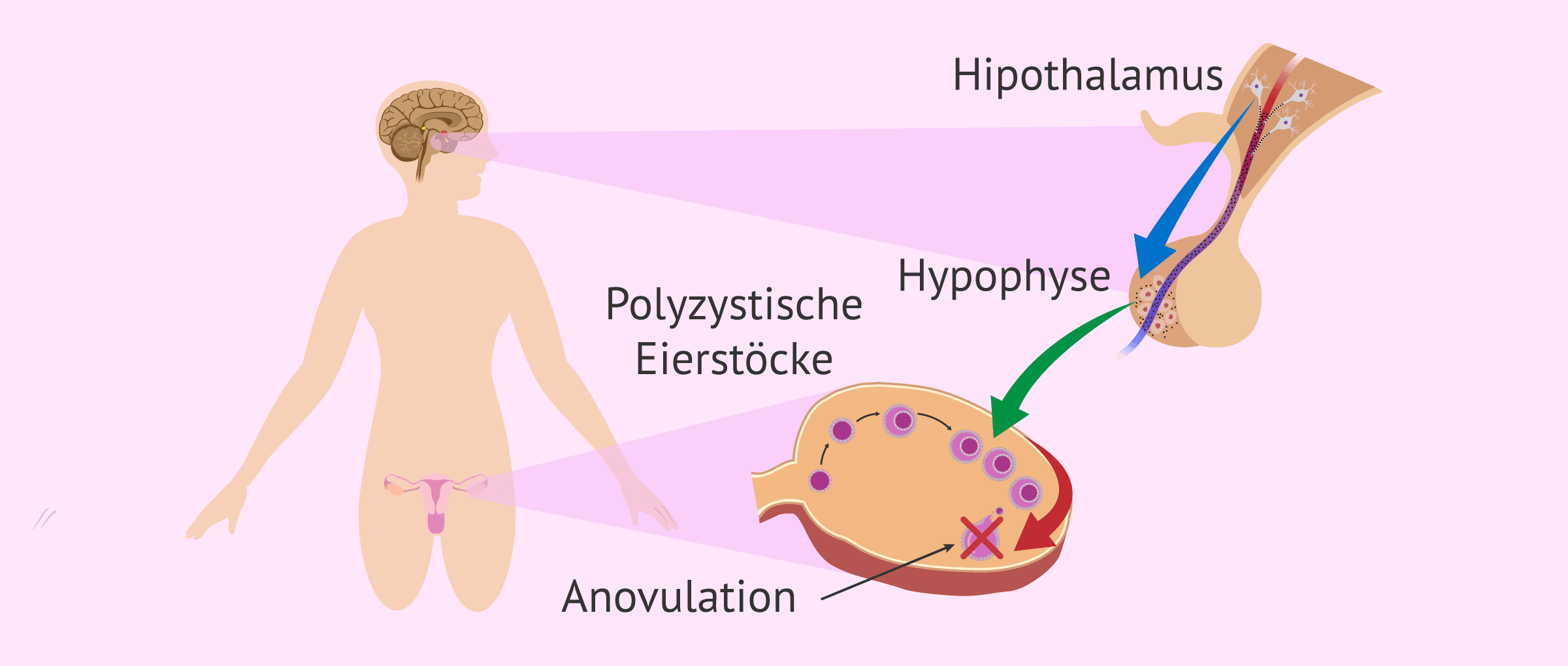 Imagen: Anovulation bei Frauen mit PCOS