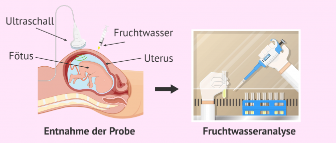 Imagen: Fruchtwasserentnahme- und analyse
