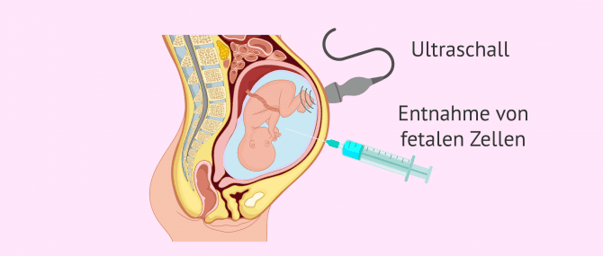 Imagen: Fruchtwasseruntersuchung