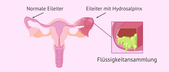 Imagen: Hydrosalpix Flüssigkeitenansammlung