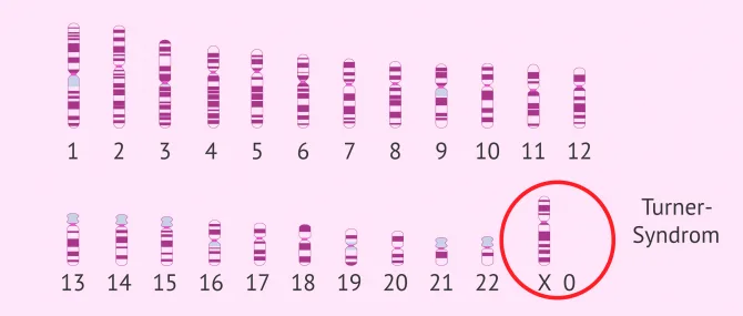 Imagen: Karyotyp Turner-Syndrom