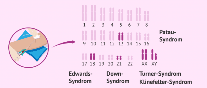 Imagen: Nicht-invasive Pränataldiagnostik im Blut der Mutter