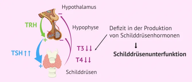 Imagen: Schilddrüsenunterfunktion und TSH-Werte