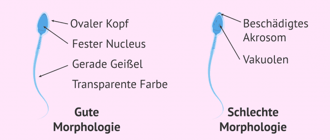 Imagen: Spermienmorphologie IMSI