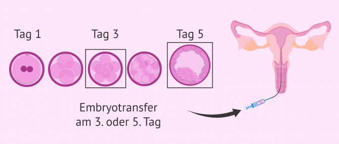 Imagen: Wann der Embryotransfer durchgeführt wird