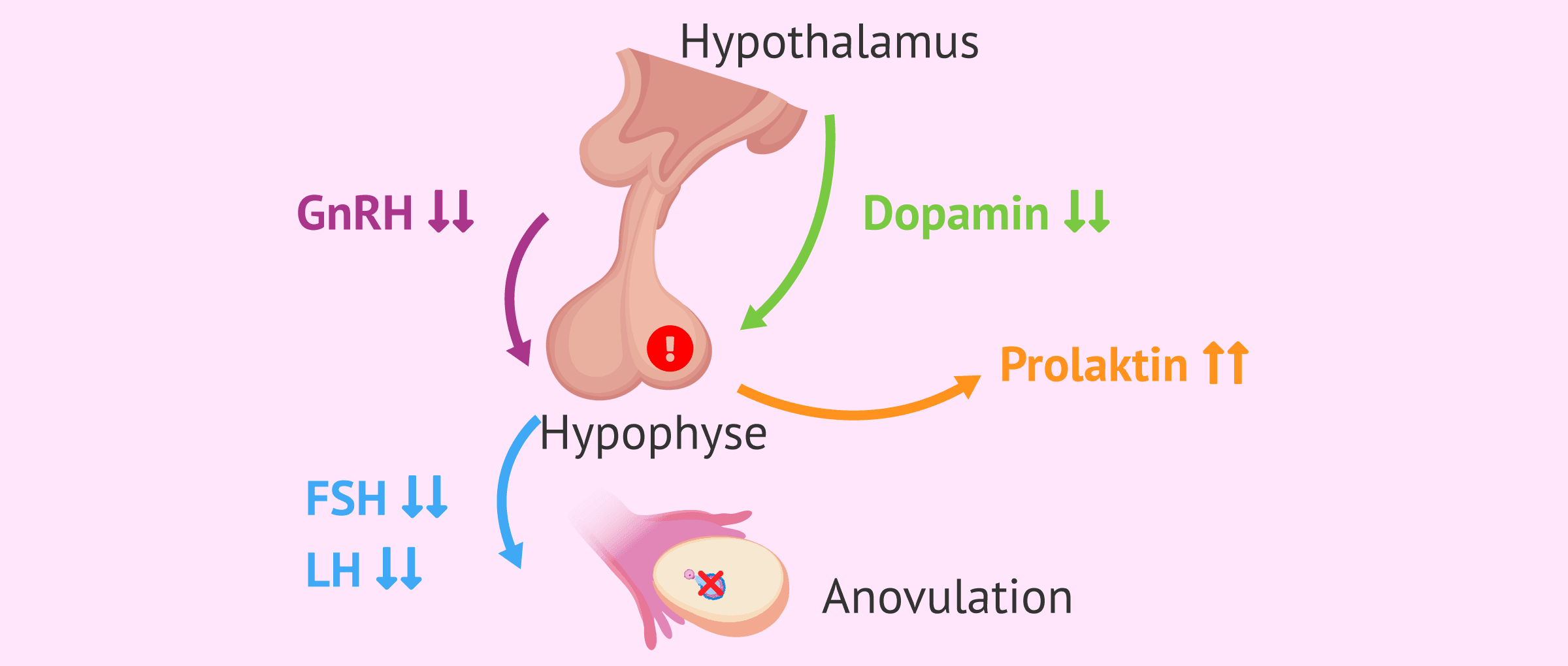Imagen: Häufigste Ursache für Hyperprolaktinämie