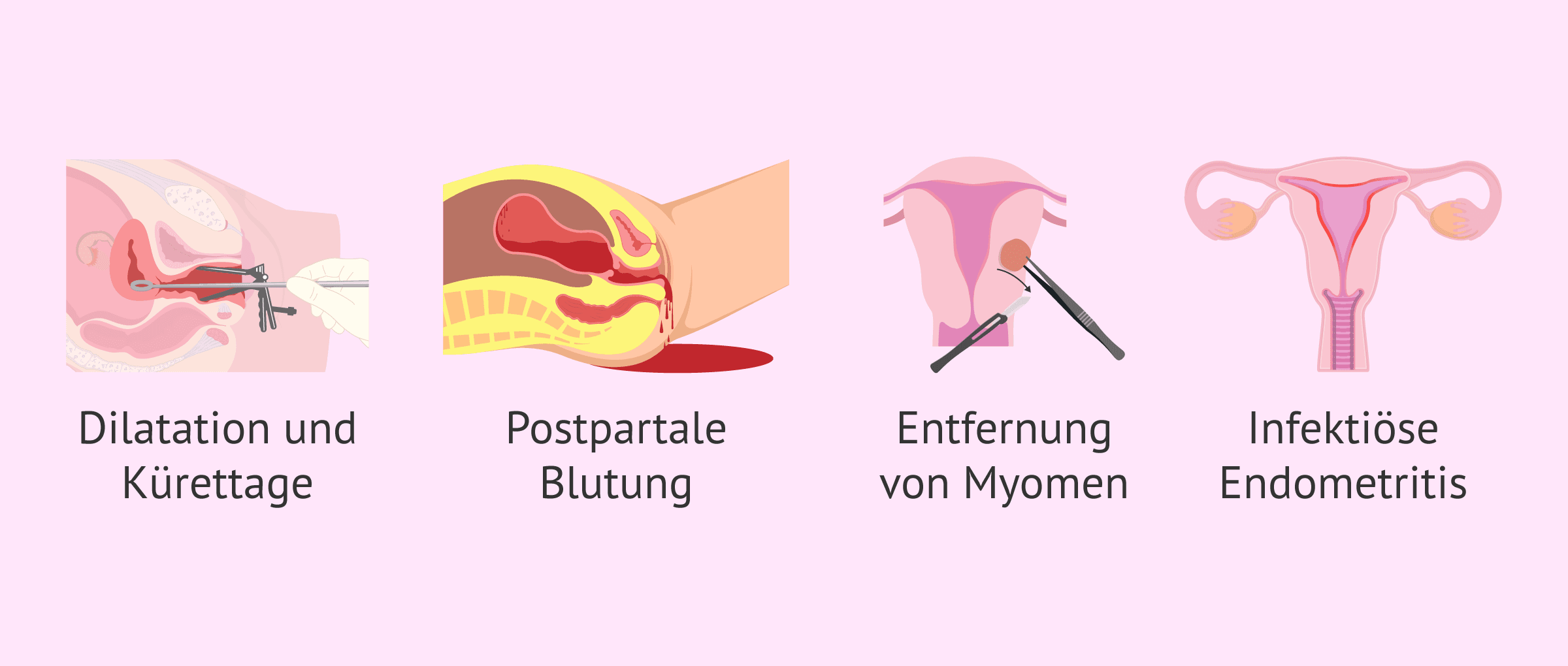 Imagen: Ursachen für uterine Synechien