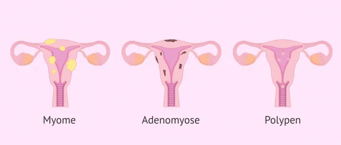 Imagen: Uterusmyome, Uteruspolypen