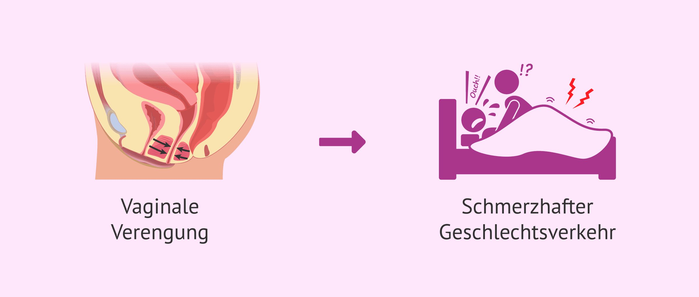 Imagen: Folgen von Vaginismus bei Frauen