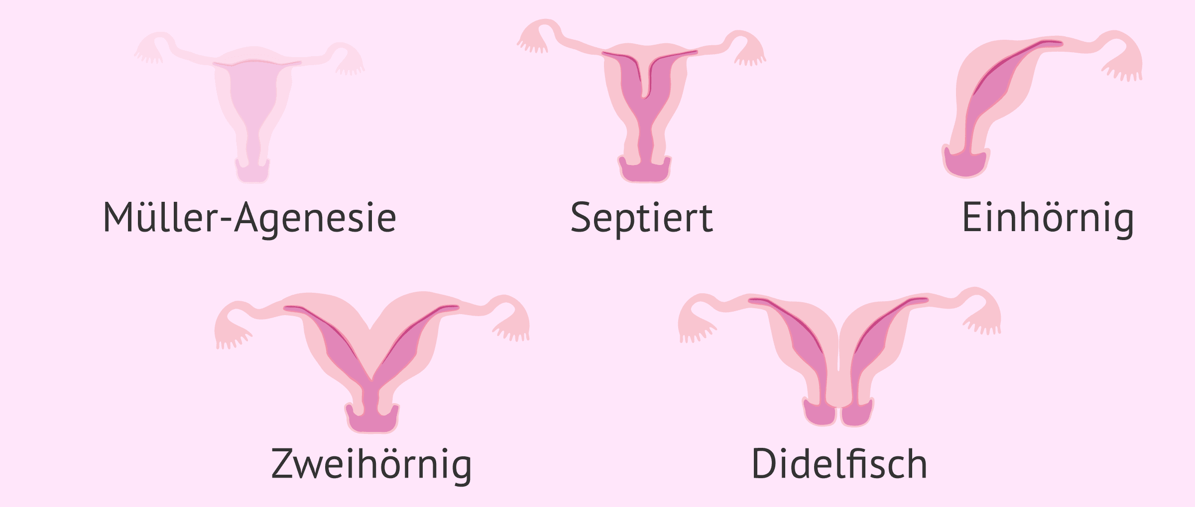 Imagen: Verschiedene Uterusfehlbildungen