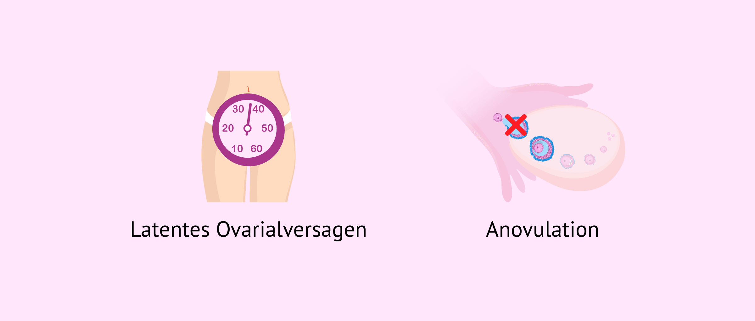 Imagen: Ovarialinsuffizienz und Anovulation