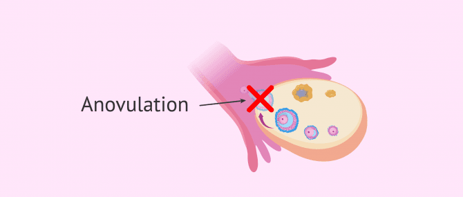 Imagen: Ausbleibender Eisprung (Anovulation)